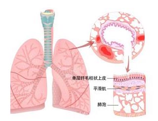 医生详解感染性哮喘的治疗费用