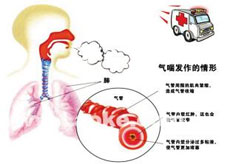 医生详解感染性哮喘的治疗费用